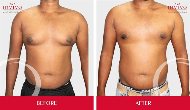 Gynecomastia-Male