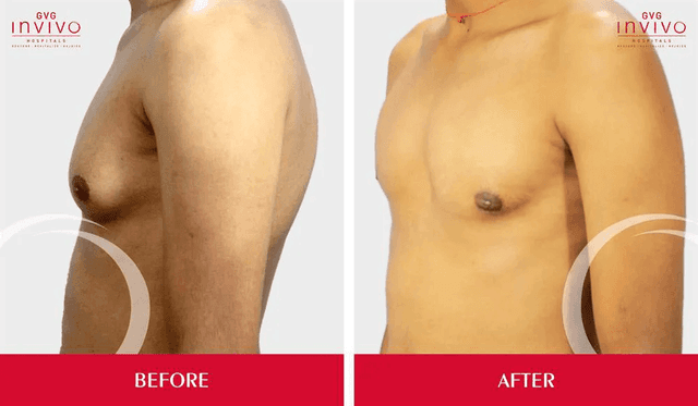 Gynecomastia