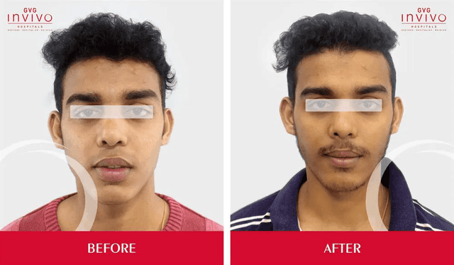 Liposuction