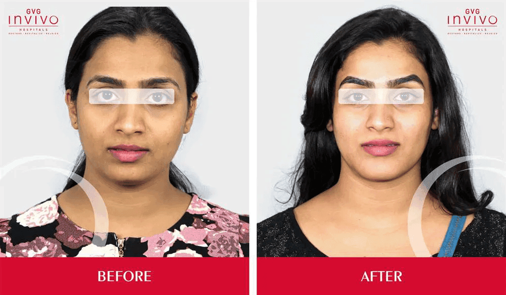 Rhinoplasty