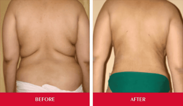 Liposuction 01